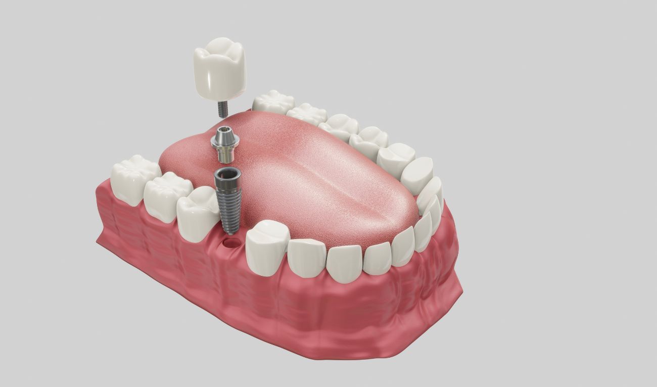 Имплантация зубов что это такое, как проводят операцию, какие импланты выбрать?