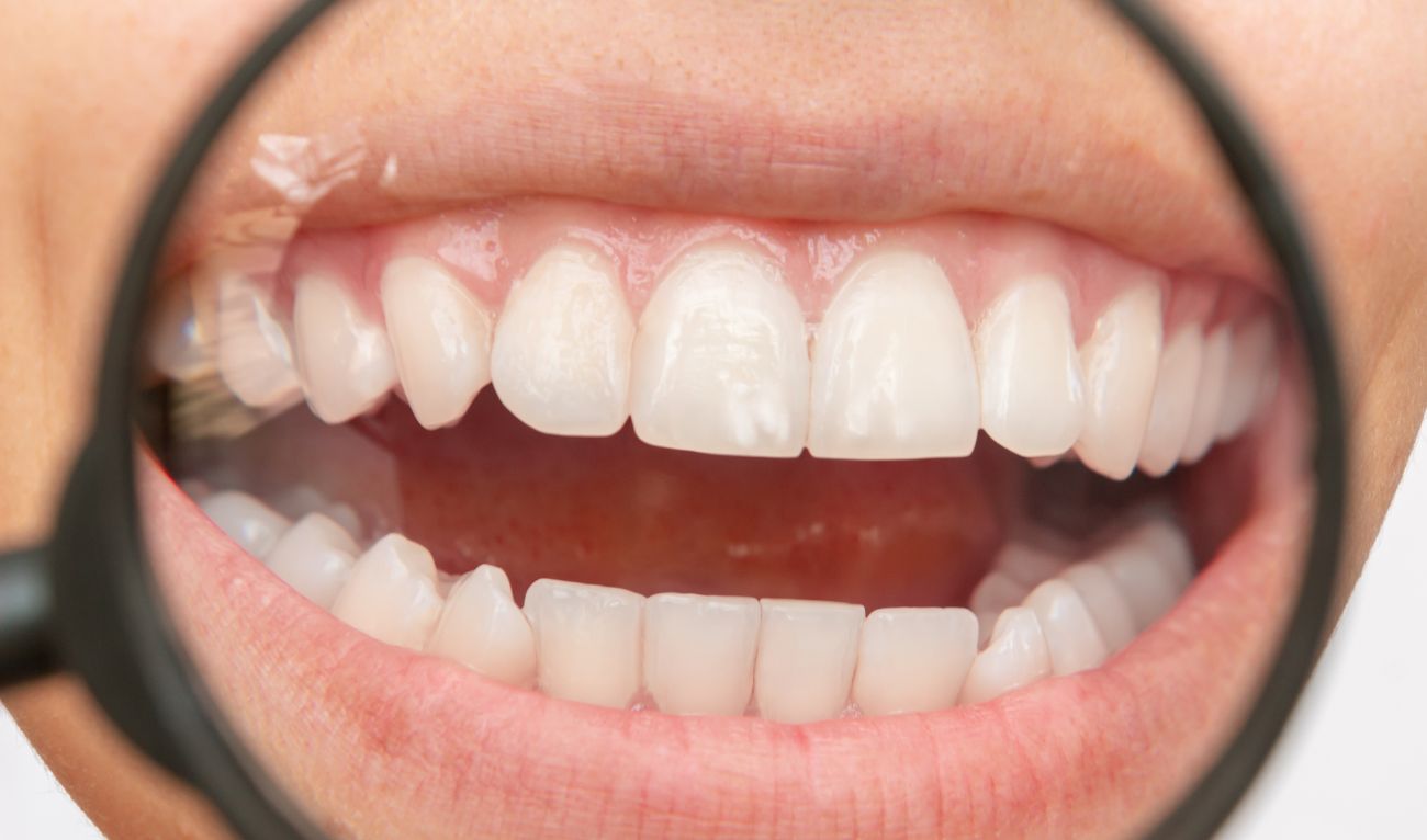 Почему у детей на зубах появляются белые пятна?