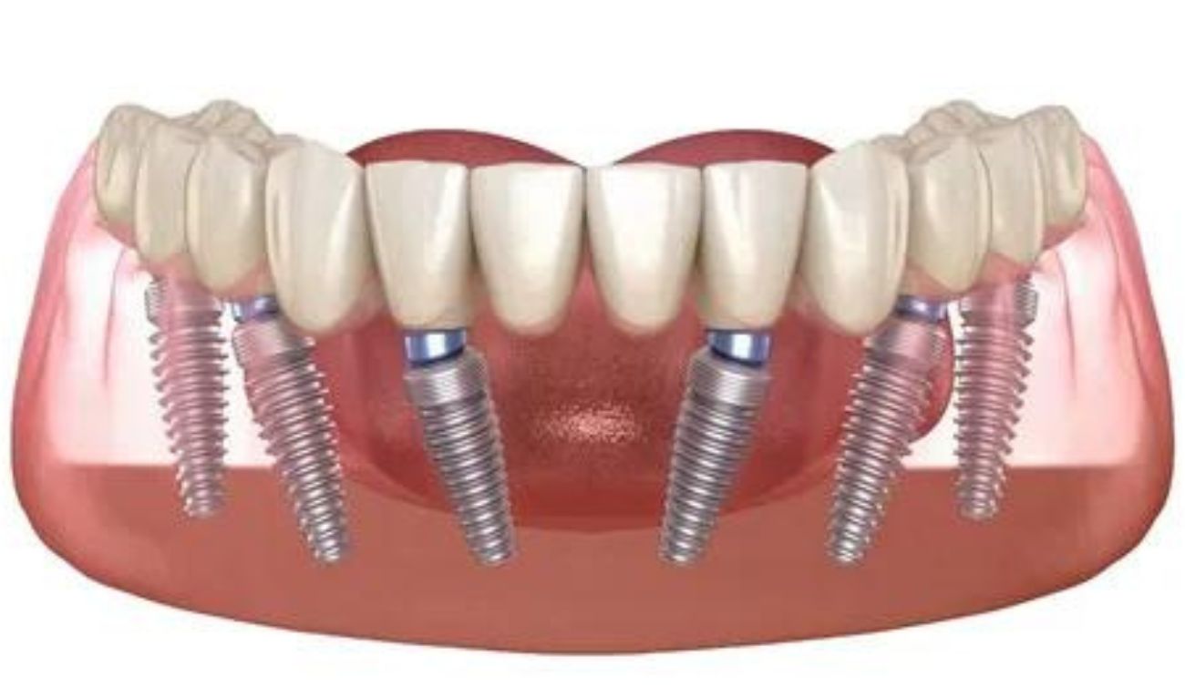 Имплантация зубов на шести имплантах