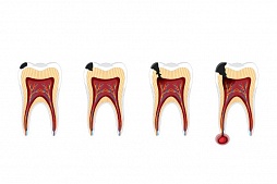 Периодонтит - симптомы, виды, лечение