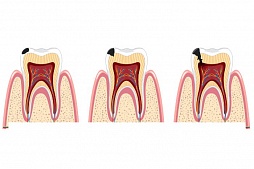 Пульпит - что это такое и как проявляется