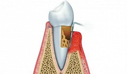 Лечение пародонтита